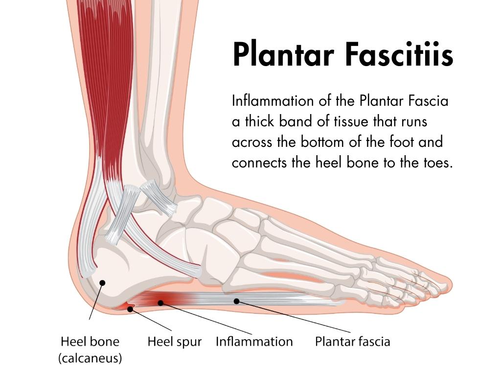 what is platar fascitiis - peak point pt provides plantar fascitiis physical therapy plantar fasciitis tips for passaic walkers and daily commuters